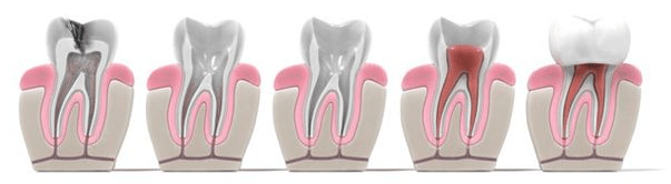 kanałowe leczenie zęba