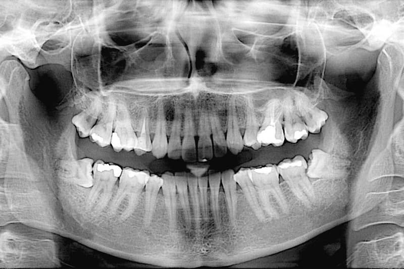 model implantu zębowego
